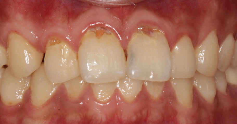 六、杭州补个牙洞多少钱？较新价目表（2026年参考）