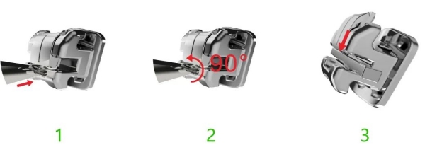 七、武汉活动牙套多少钱一颗?总结与建议