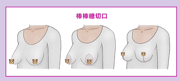 七、常州美莱美容整形胸部整形价格区间