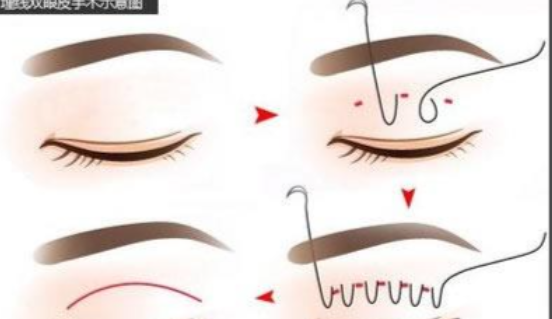 四、库尔勒全切双眼皮手术方式对价格的影响