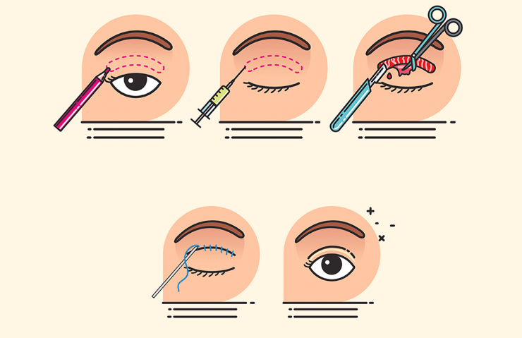 二、开完眼角后硬结如何处理?科学有效的应对方法