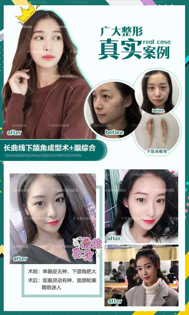 五、广州广大整形医院磨骨手术价格与其他医院对比