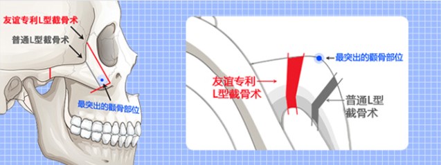 四、轮廓塑形组合：下颌线收紧的辅助方案