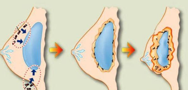 二、平胸做曼陀水滴270中凸可以达到什么罩杯？实际实例参考