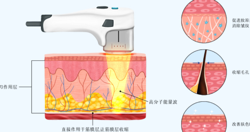 超声炮美肤是什么原理？高强度聚焦超声技术刺激胶原蛋白再生