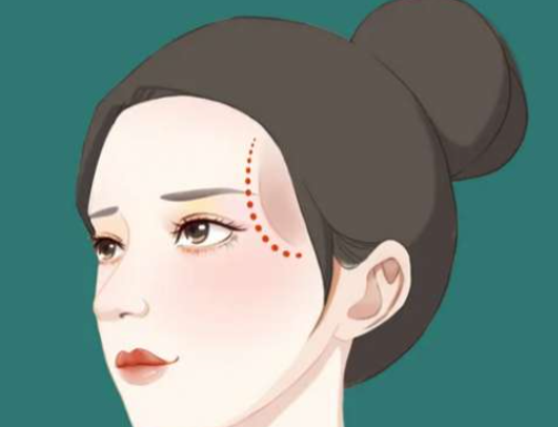 二、濡白天使适用于太阳穴填充的原因