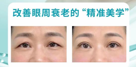 三、45岁提眉5年后的真实感受：影响疗效维持的关键因素