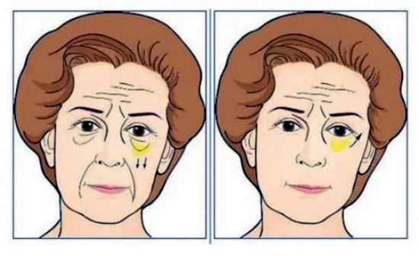 二、选择外切祛眼袋机构时需要关注哪些因素？