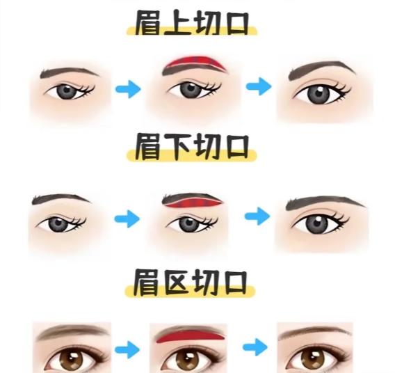 提眉手术多少钱大概？眉上切口大概3000起，内窥镜提眉贵