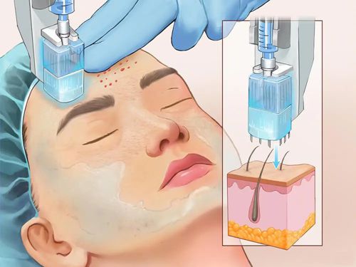 二、超声炮和热玛吉的区别是什么｜适用人群与禁忌症