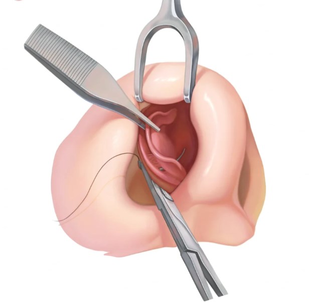 二、男生隆鼻的常见手术方式及价格参考