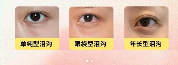 二、泪沟填充的维持时间：不同材料的持久性对比