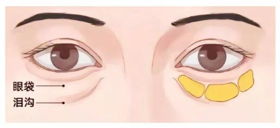 三、使用泪沟改善产品需注意的事项