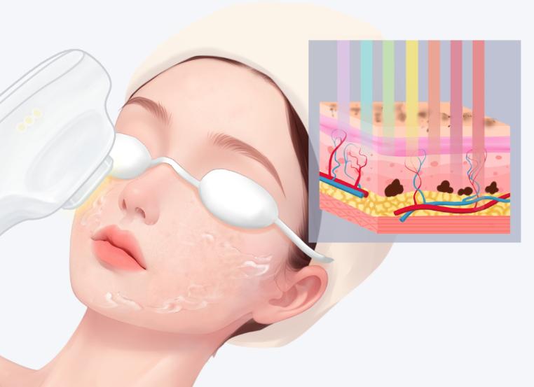 为什么医院的光子比美容院的贵？设备更专业价格自然高