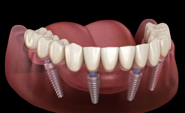 三、恩施咿呀牙科价目表：透明收费，合理价格