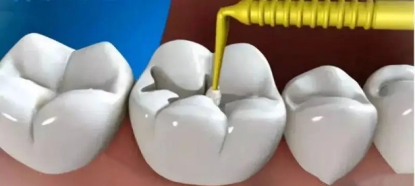 树脂补牙能维持多久？进口3M树脂寿命达8年更持久！