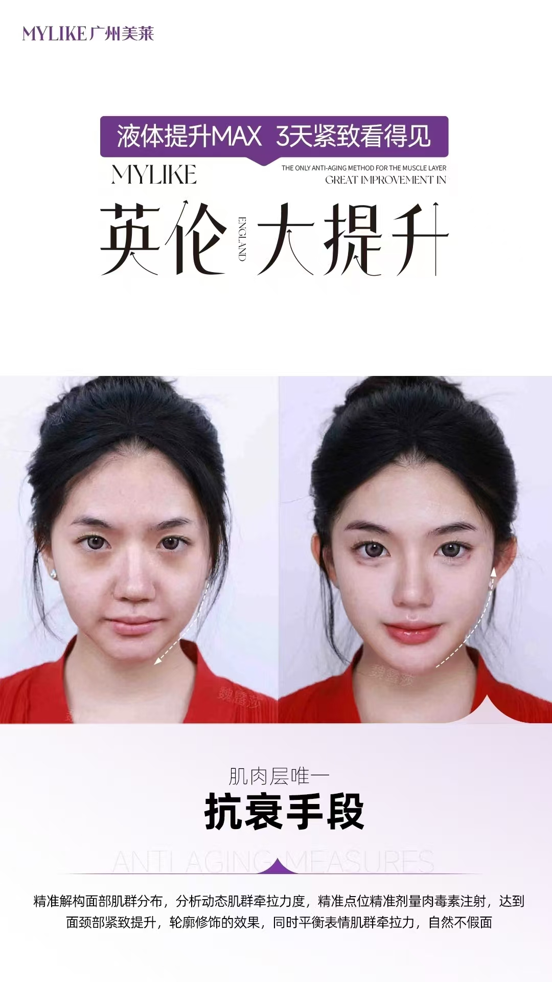 五、广州美莱超声炮术后较快不伤皮肤？冷敷护理更持久