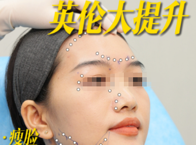 四、艺星医疗美容医院打英伦大提升有哪些优势?对比其他项目