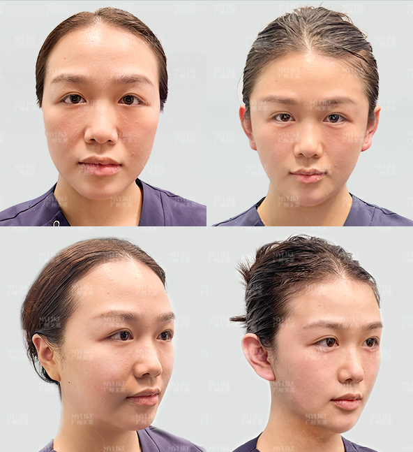 二、广州美莱医疗美容抽脂价格多少？腰腹环吸9800元起