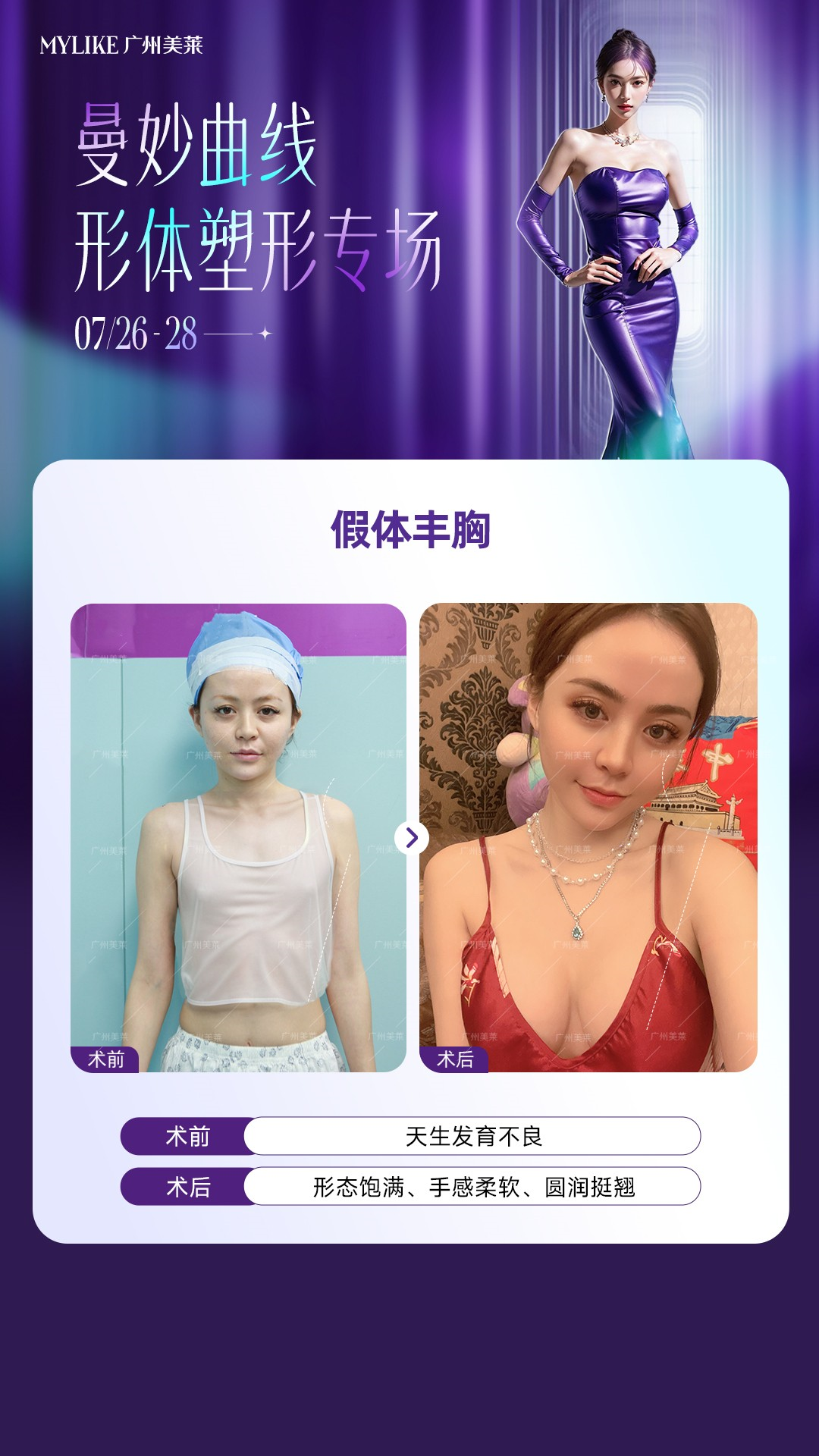 三、广州美莱医疗美容抽脂技术靠谱吗？5G光雕+分层环吸凹凸率＜0.5%