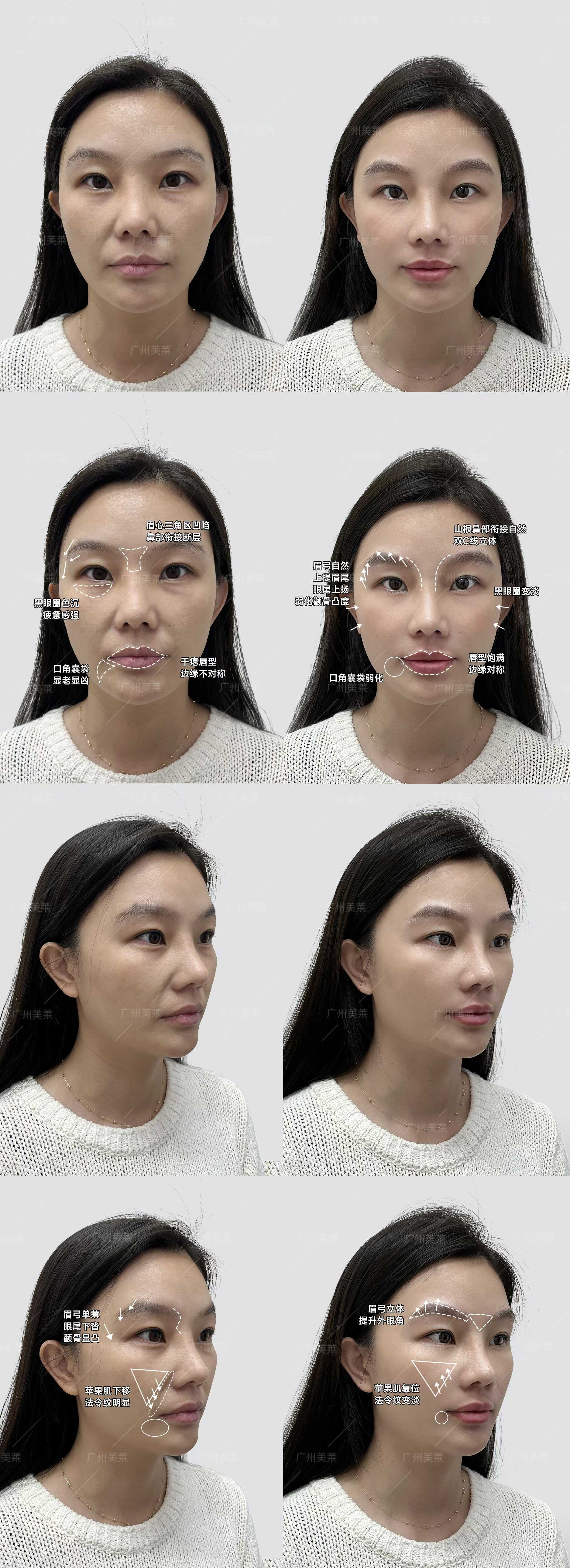 七、广州美莱医疗美容抽脂适合哪些人？产后腰腹、大腿根摩擦者