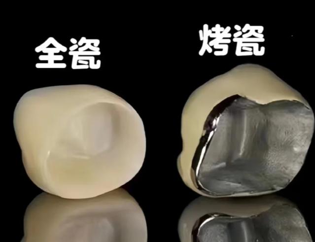 烤瓷牙重新粘一下多少钱？200-800元不等看材质和医院