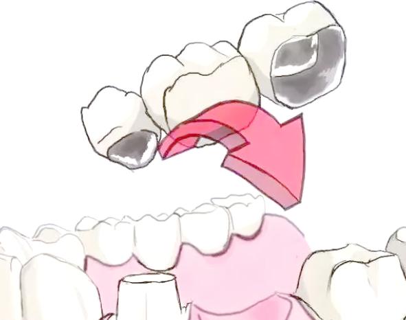 三、烤瓷牙重新粘一下多少钱？常见误区与注意事项