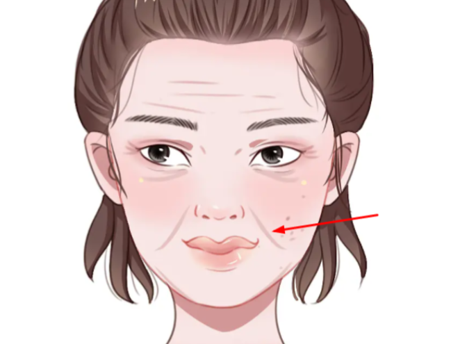 三、法令纹三件套注意事项｜规避治疗风险