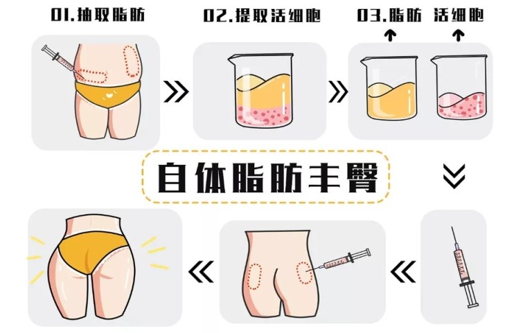 三、脂肪丰臀术前术后注意事项