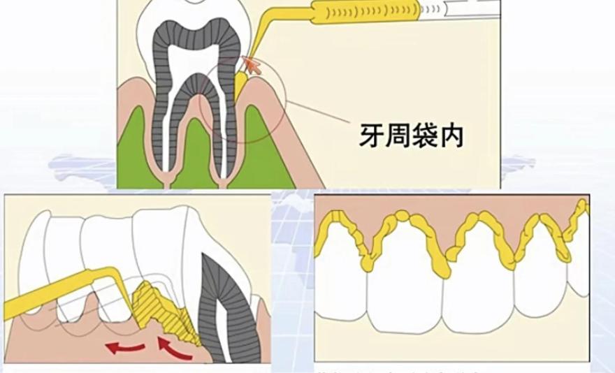 牙槽骨为什么会被吸收？3个常见原因+修复方法全解析，速看！