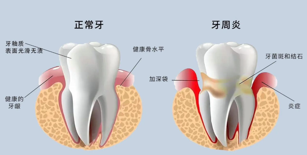 三、手术治疗：中重度牙周炎的解决方案