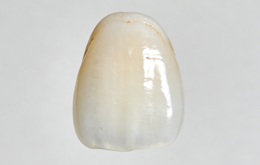 牙缝大做了牙贴面后脱落可以再矫正吧？专家说能修复但需注意这些细节