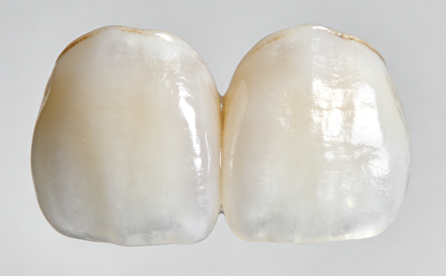 二、牙贴面脱落后的处理方案解析