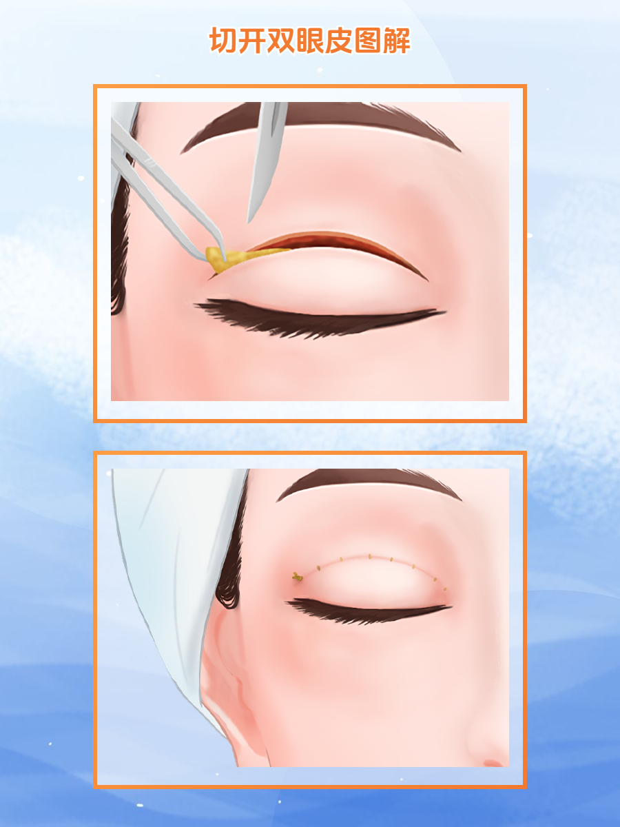 西安双眼皮张瑞昌做的怎么样？用户反馈87%满意，西安画美医院设备标准化