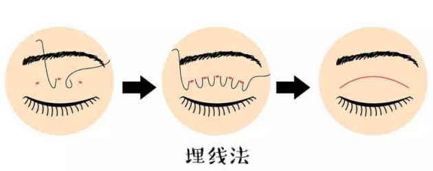 三、蝴蝶袖埋线疗效好吗｜治疗前后的关键注意事项
