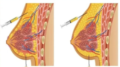 隆胸200cc是什么罩杯？真实测评揭秘对应尺寸与穿内衣建议！