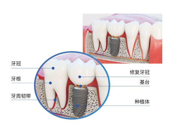 三、选择诺贝尔种植体的常见误区与避坑指南