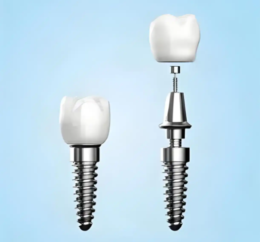 2026年种植一颗牙的费用均价曝光！医保报销比例与品牌差异全解析