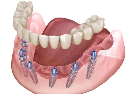 二、影响种植牙价格的关键因素