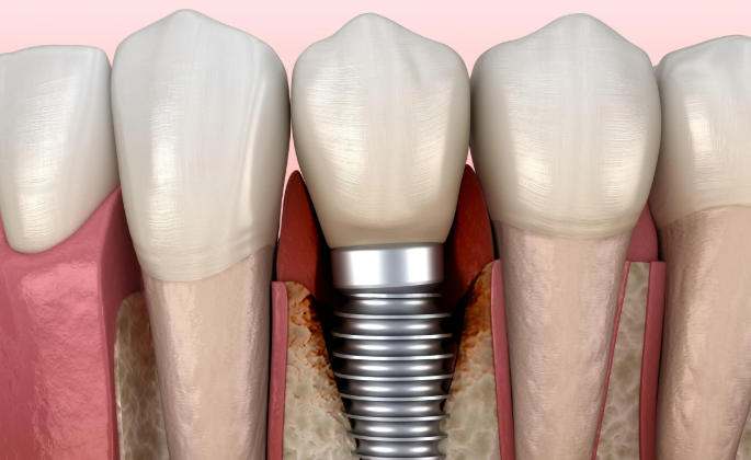 士卓曼种植体怎么样？全球前三品牌真实测评：用户评价超3万条