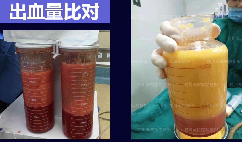 二、鼻梁脂肪填多了的改善方案