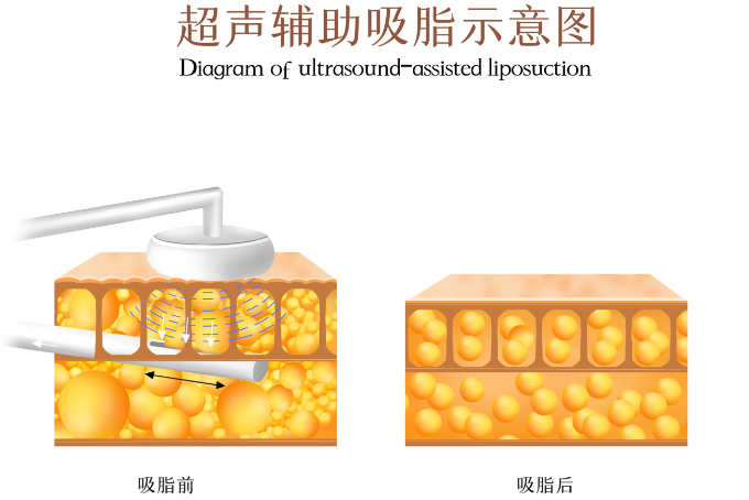 二、吸脂手术引发神经损伤的常见原因