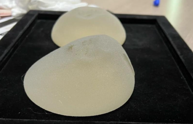 二、陶宏炜隆胸手术的术后疗效与患者反馈