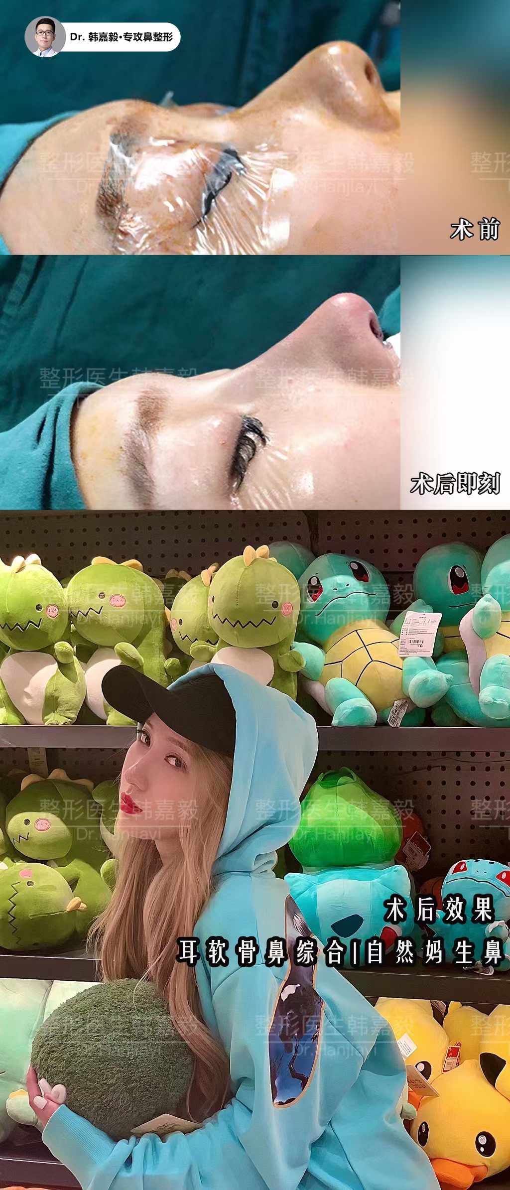 六、韩嘉毅鼻子属于几线医生?上海伯思立高难度鼻修复前六强