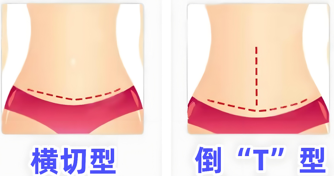 三、艾剑英腹壁整形口碑中的价格体系与性价比