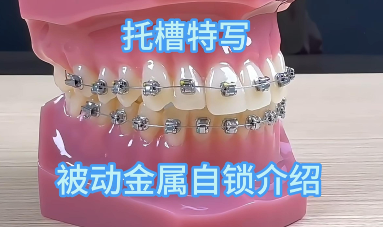 金属自锁会磨嘴吗？亲测比传统托槽舒适度提升60%；金属自锁托槽会磨嘴吗？95%用户反馈几乎不刮口腔