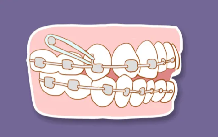 二、金属自锁托槽磨嘴的常见原因及应对方法