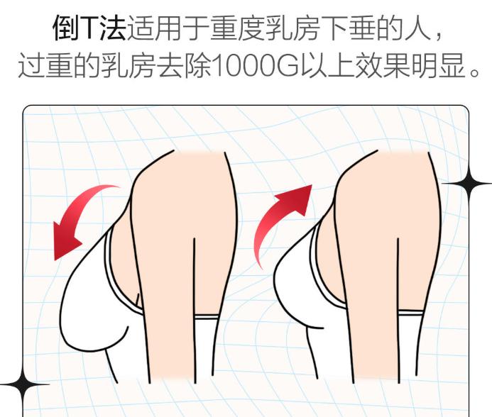 长春哪个医院做缩胸手术好？2026年这三家机构技术口碑双在线（附吉大医院200+案例）