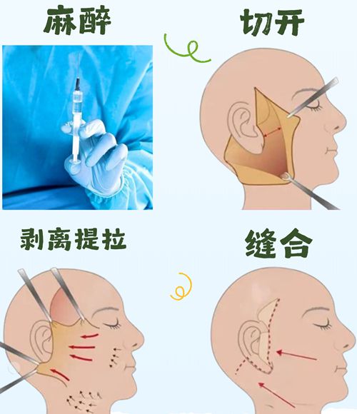 四、广东陈兵拉皮:价格对比与避坑指南