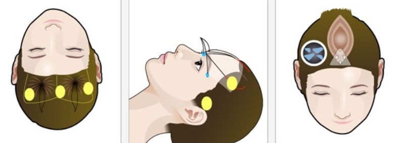 三、广州陈兵医生做拉皮手术:资质、经验与技术优势全维度解析